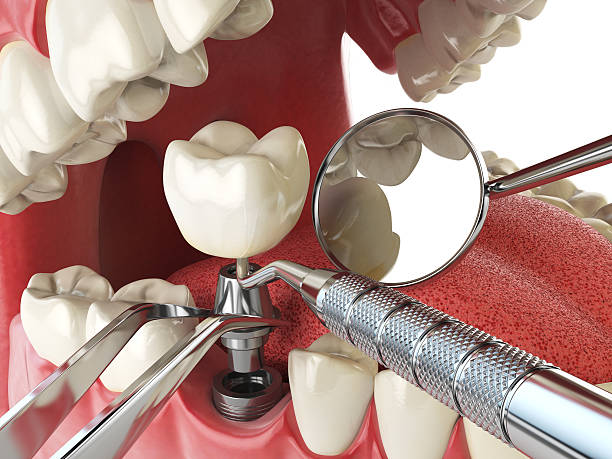 Best Emergency Dental Care for Broken or Chipped Teeth in Winter Gardens, CA